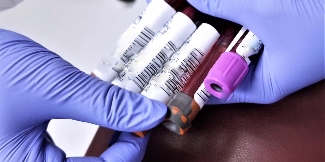 Breakthrough in Early Detection: Private Blood Testing for Ovarian and Pancreatic Cancers